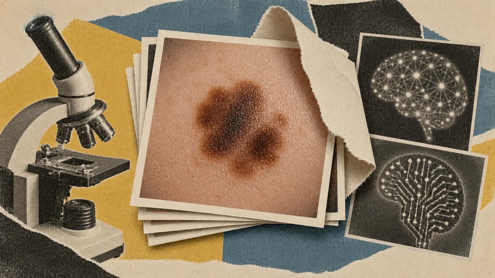 Older CNN Beats Frontier AI in Skin-Cancer Test